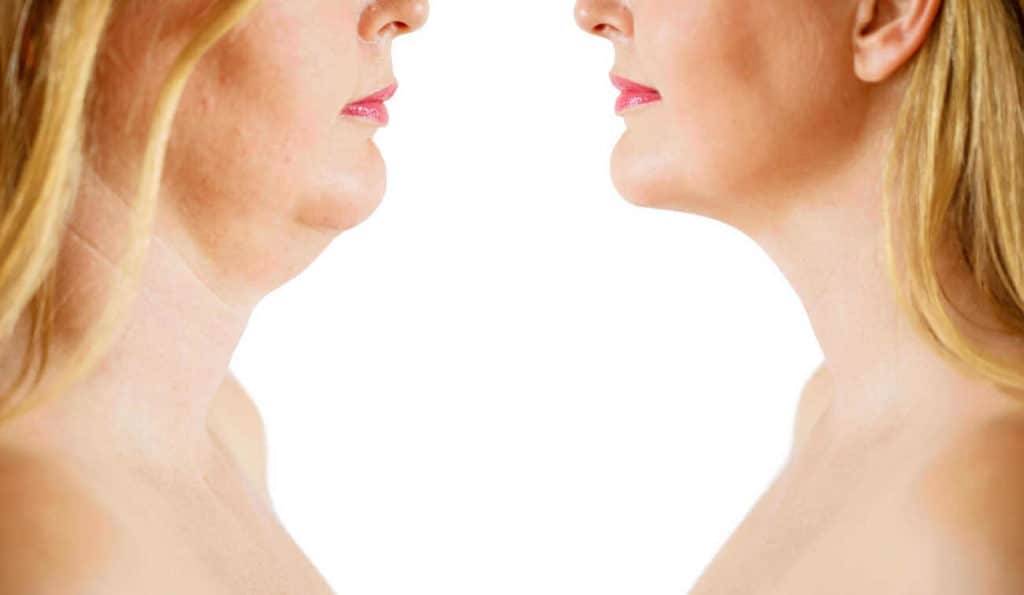 Double Chin treatment Blackheath before and after results