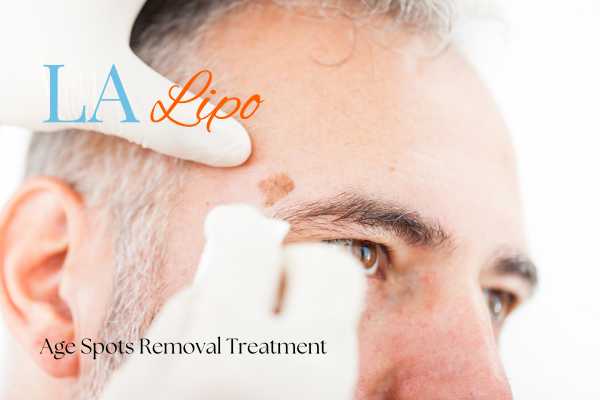 What Are the Most Effective Treatments for Age Spots Blackheath?
