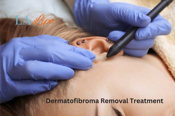 Dermatofibroma Removal Treatment Blackheath
