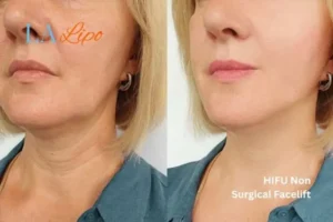 hi-fu for wrinkles Blackheath before and after results
