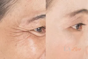 Before and after results of woman - HI-fu wrinkles reduction treatment Blackheath