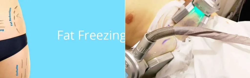Fat freezing Blackheath on multiple areas of the body