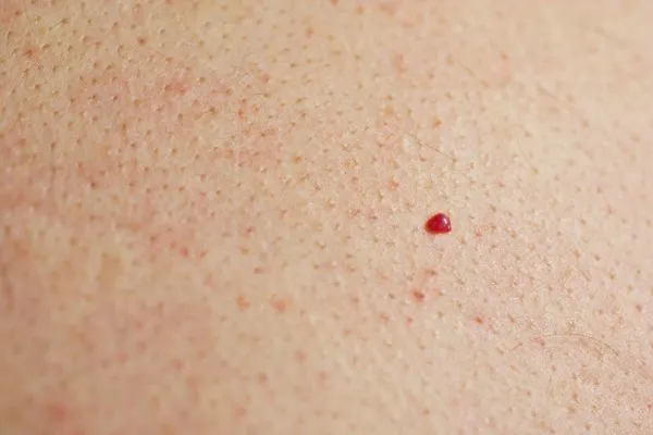 close up of a cherry angioma Blackheath