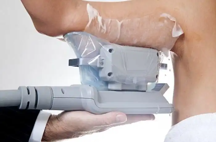 Picture of fat freezing Blackheath on the upper arms.