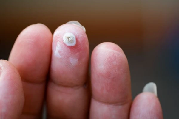 wart on person finger - cryotherapy to treat from LA LIPO Blackheath