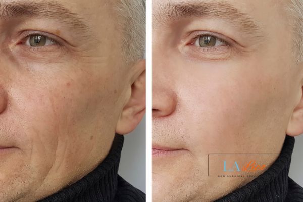 See the amazing results of Morpheus8 Treatment Blackheath!