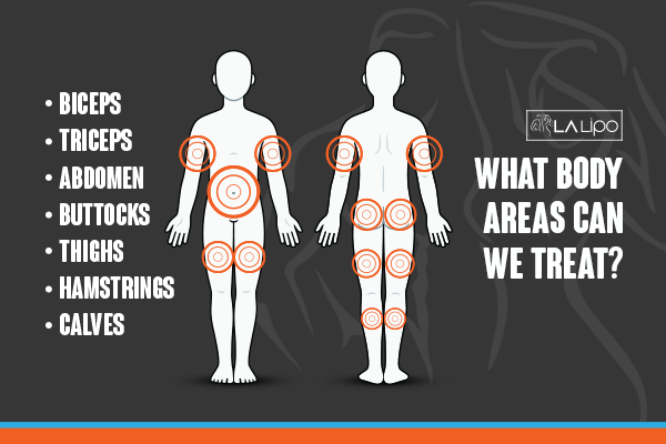 Diagram to show areas you can have LA-EMS Body Sculpting Treatment Blackheath