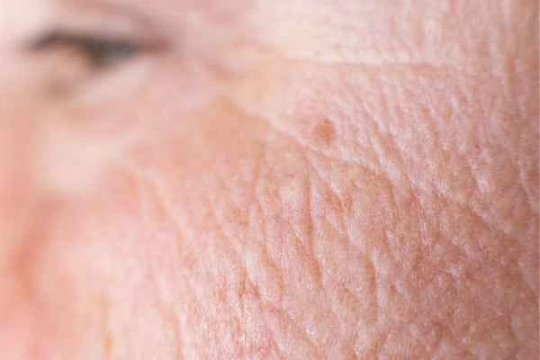 close up picture of a woman's face showing an age spot Blackheath
