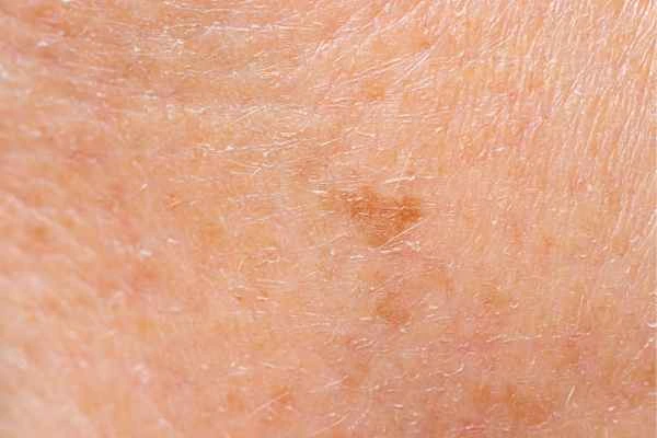 close up picture of age spots Blackheath