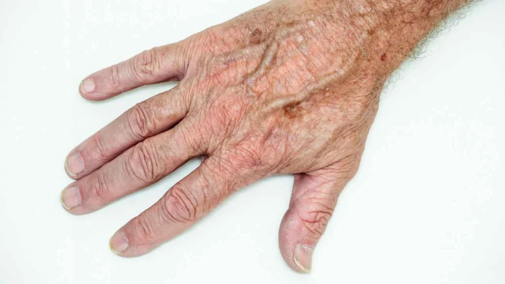 Male hand showing age spot Blackheath