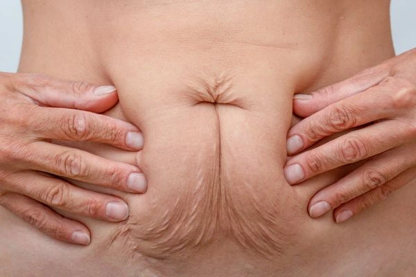Image of a woman's stomach with loose skin - example of skin tightening Blackheath options