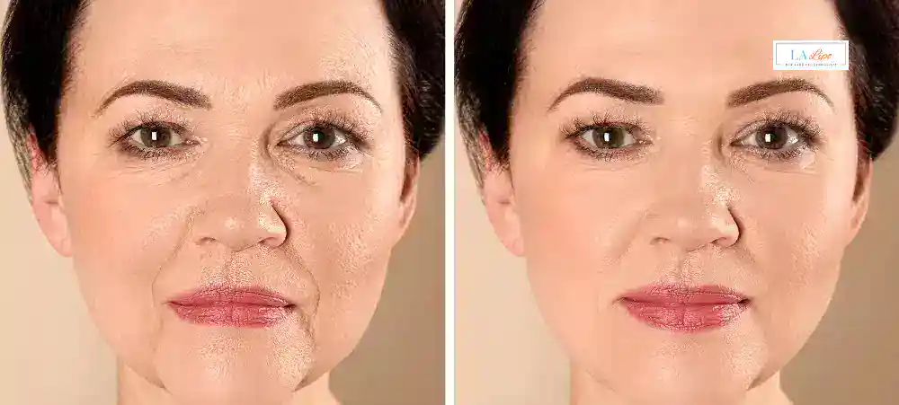 How Long Does It Take to See Results and How Long Do They Last Blackheath?