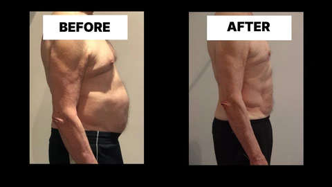 What Symptoms Can Diastasis Recti Cause in Men? Weak Core, Back Pain and Poor Posture Blackheath